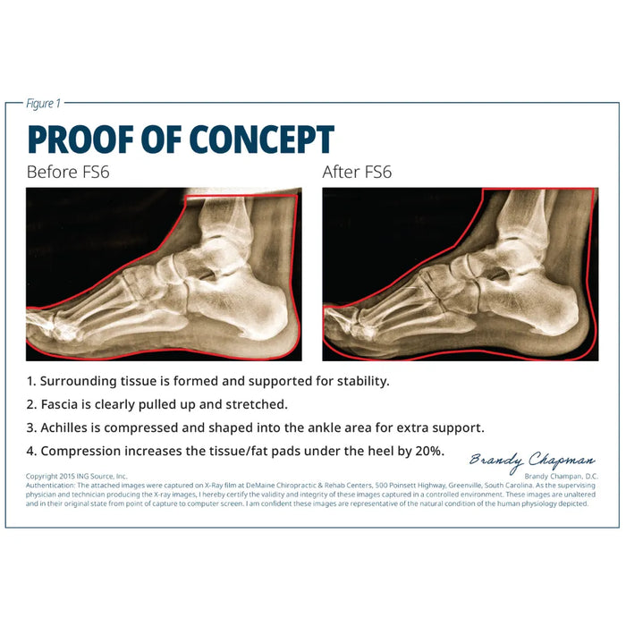 X-ray comparison of a foot before and after FS6 treatment, labeled 'Proof of Concept'.