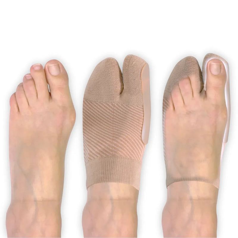 comparison of foot with bunion before and during HV3 bunion bracing sleeve use | OS1st